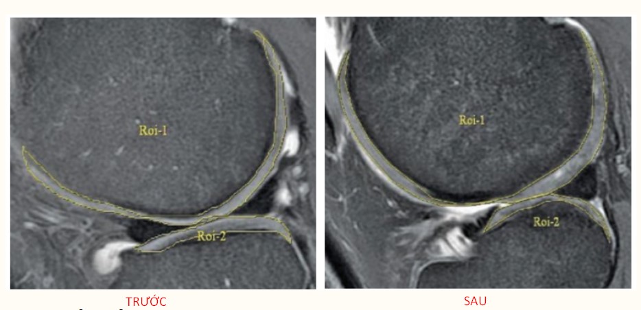 Kết quả khả quan cho trị liệu thoái hóa khớp gối sau 6 tháng